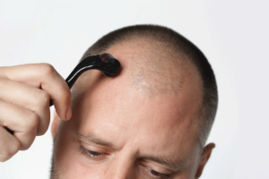 Derma Roller on bald scalp